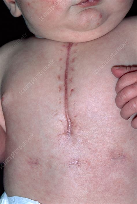 Scar After Infant Heart Surgery Stock Image M3320093 Science