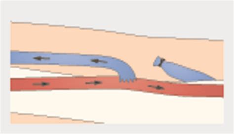 Arteriovenous Fistulas The Bmj