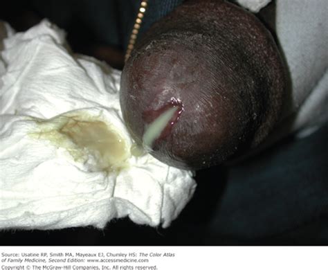 So, what does a chlamydia discharge look like? Chapter 215. Urethritis in Men | The Color Atlas of Family ...