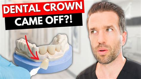 What Should I Do If My Dental Crown Falls Off Youtube