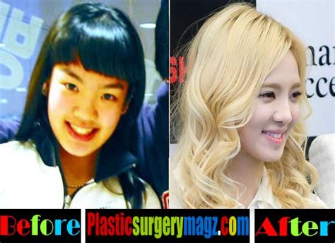 Girls Generation Plastic Surgery Is Finally Revealed Plastic Surgery Magazine