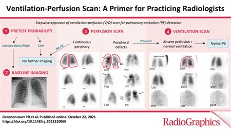 Ventilation Perfusion Scan A Primer For Practicing Radiologists