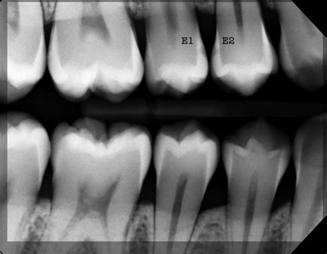 Radiology Of Dental Caries Pocket Dentistry