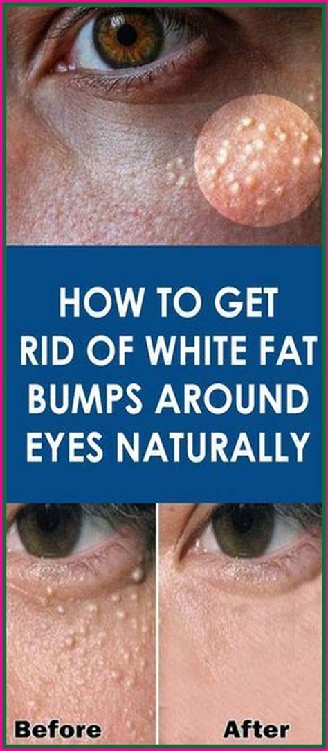 10 White Bumps On Skin Image Ideas