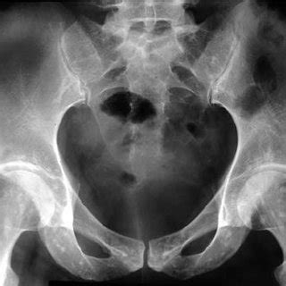Osteopathia striata is an uncommon sclerosing bone dysplasia that remains mostly asymptomatic. Vertical striations around the knee in osteopathia striata ...