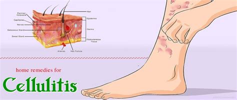 22 Science Backed Home Remedies For Cellulitis On Face And Body