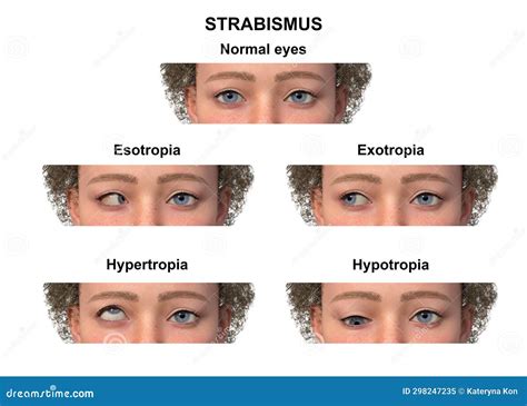 A Child With Various Strabismus Types 3d Illustration Stock