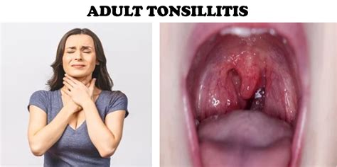 ADULT TONSILLITIS Symptoms Diagnosis Treatment And Care