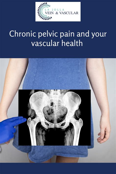 Vein And Vascular Treatment Chronic Pelvic Pain