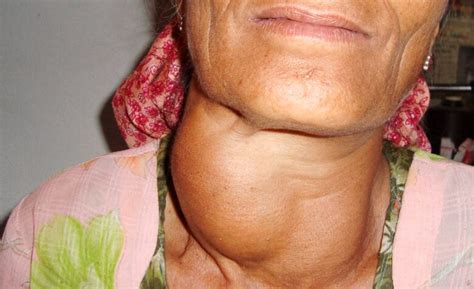 11 Goiter Treatment Without Surgery Causes And Symptoms The News God