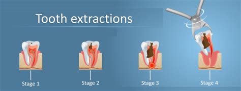 Frisco Tooth Extraction With Oral Surgery Highland Oak Dental