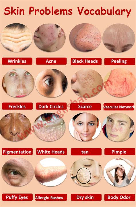 How To Recognize What Kind Of Acne You Have Innate Skin Artofit