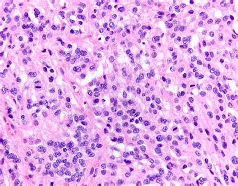 Pathology Outlines Who Grading Of Meningiomas