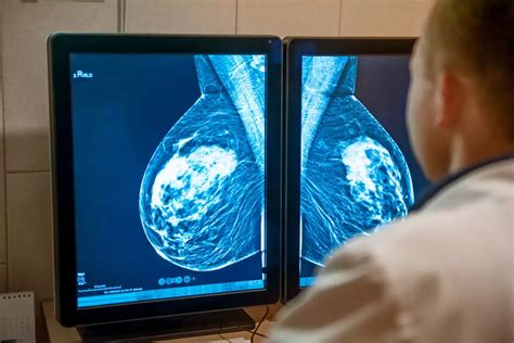 Mamografia O Que é Importância E Quando Deve Ser Feita