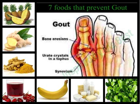 7 Foods That Prevent Gout Foods That Cause Gout Gout Prevention