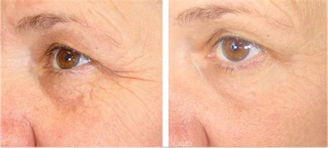 Non Surgical Eye Lift — Advanced Dermatology