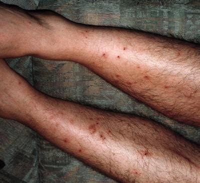 Im notfall wissen, was zu tun istinsect bites and stings: Invasion der Flöhe
