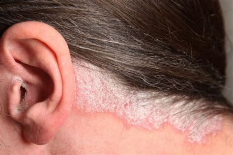 Scalp Psoriasis Treatment At Pine Belt Dermatology And Skin Cancer Center