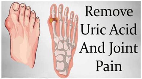 How To Remove Gout And Joint Pain Uric Acid And Crystals Youtube