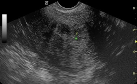 Atrophic Endometrium 2 Mm By Tvs Download Scientific Diagram