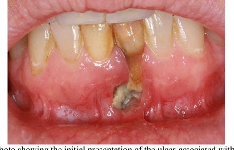 Mouth Ulcer In Diabetic Patient Diabeteswalls