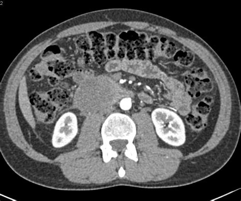 Pancreatic Cancer With Tumor Spread Pancreas Case Studies Ctisus Ct