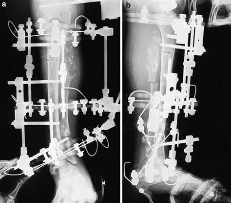 A Ap And B Lateral Views Of The Tibia Proximal Osteotomy Was
