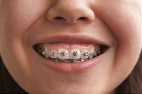 Traditional Braces In Fort Worth