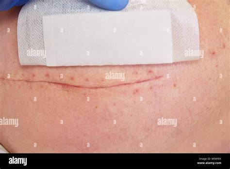 Scar After Hip Replacement Surgery Hi Res Stock Photography And Images