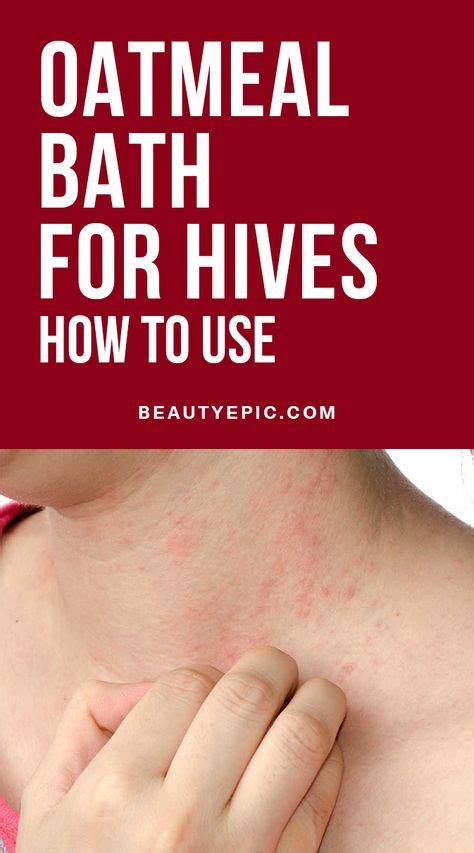 10 Hives Remedies Ideas Hives Remedies Hives Urticaria