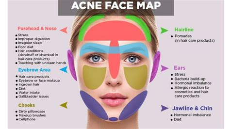 Acne Face Map What Is Causing Your Acne Dandn Medical Series Youtube