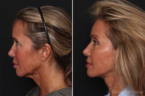 Facelift Before And After Princeton Nj