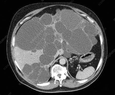 Polycystic Liver Disease Ct Scan Stock Image C0194455 Science