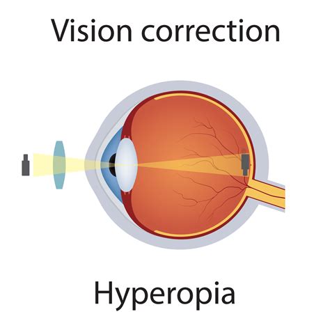 Vision Correction Of Hyperopia Illustration Eyesight Disorders Eyes