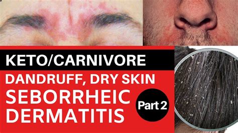 Ketocarnivore Dandruff Dry Skin And Seborrheic Dermatitis Part 2