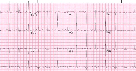 Dr Smiths Ecg Blog Adding To The Many Faces Of Hypokalemia
