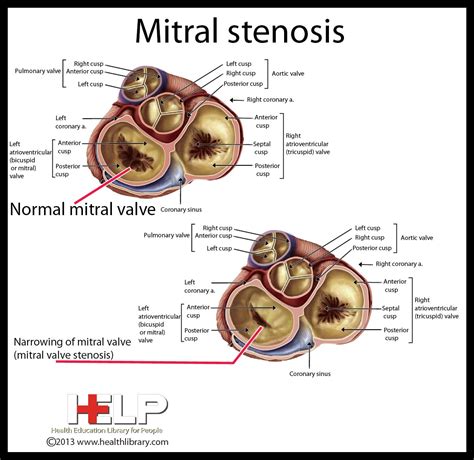 Mitral Stenosis Diagnostic Medical Sonography Cardiac Nursing