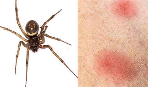 What Does A Spider Bite Look Like What Does A Spider Bite Look Like