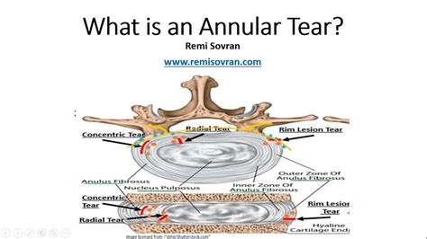 What Is An Annular Tear And Why It Is Important For You To Understand
