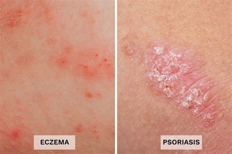 Eczema Vs Psoriasis 13 Differences You Should Know The Healthy