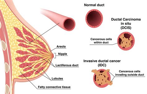 Invasive Ductal Carcinoma Diagram