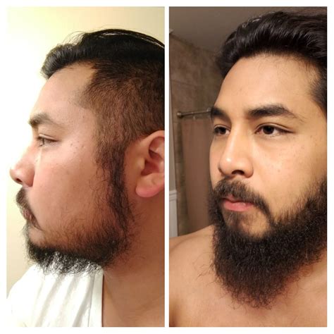 Minoxidil Beard Before And After Pictures For A Lot Of Men Growing A