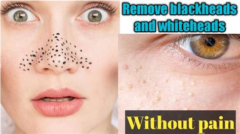 How To Remove Blackheads And Whiteheads Naturally At Home Without Pain
