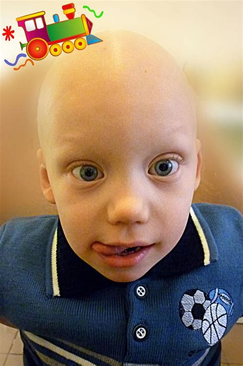 A new approach to the prevention and cosmetic treatment of alopecia aminexil. Pin on Children Hair Loss, Alopecia Areata, Alopecia ...