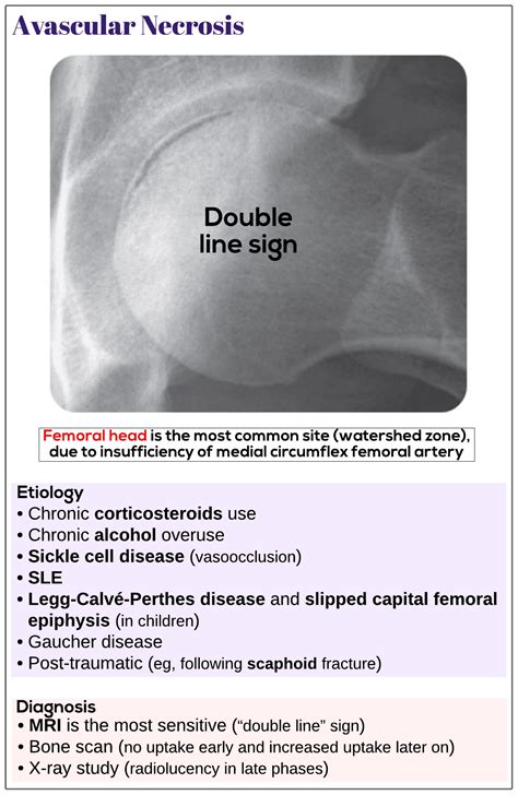 Avascular Necrosis Avn Medicine Keys For Mrcps