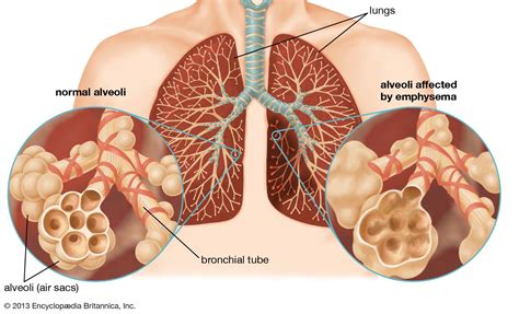 Respiratory Disease Definition Causes And Major Types Britannica Free