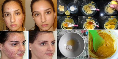 Best Home Remedy To Get Rid Of Pimples Fast Life With Styles