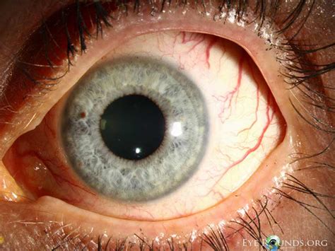 Atlas Entry Ocular Hypertension Dilated Episcleral Vessels Blood In