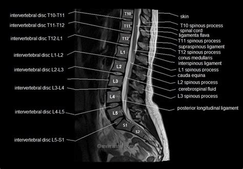 Mri Spine Anatomy Free Mri Lumbar Spine Sagittal Cross Sectional
