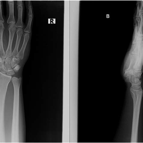 Normal X Ray Of The Right Wrist At The First Visit To The Clinic A
